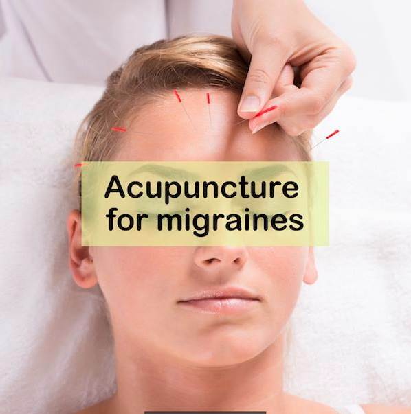 acupuncture treatment for migraine relief