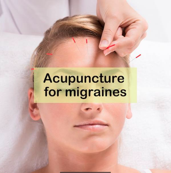 picture of acupuncture treatment for migraines in omaha nebraska