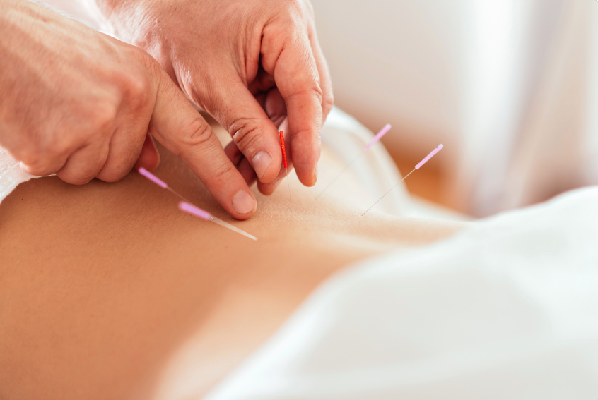 acupuncture for low back pain