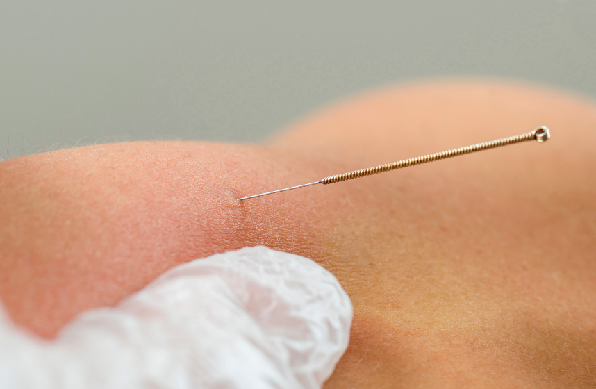 image of dry needle insertion for dry needling therapy