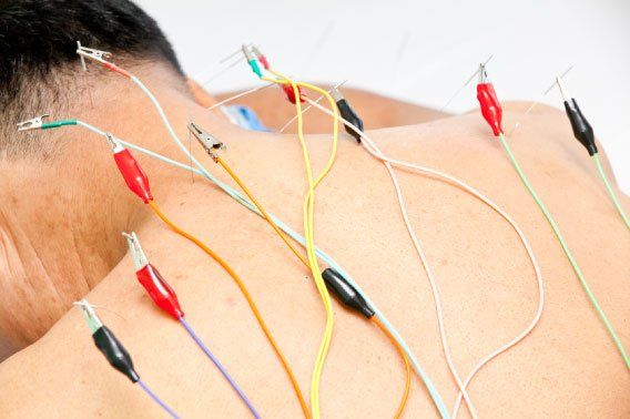 Acupuncture with Electro-Stimulation in Santa Monica/Los Angeles