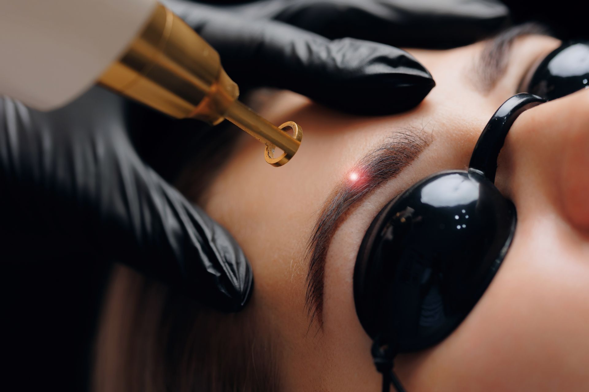 Laser tattoo removal on eyebrow, performed by gloved hand. Lasers on dark brown tattooed brow. Person wearing eye protection.