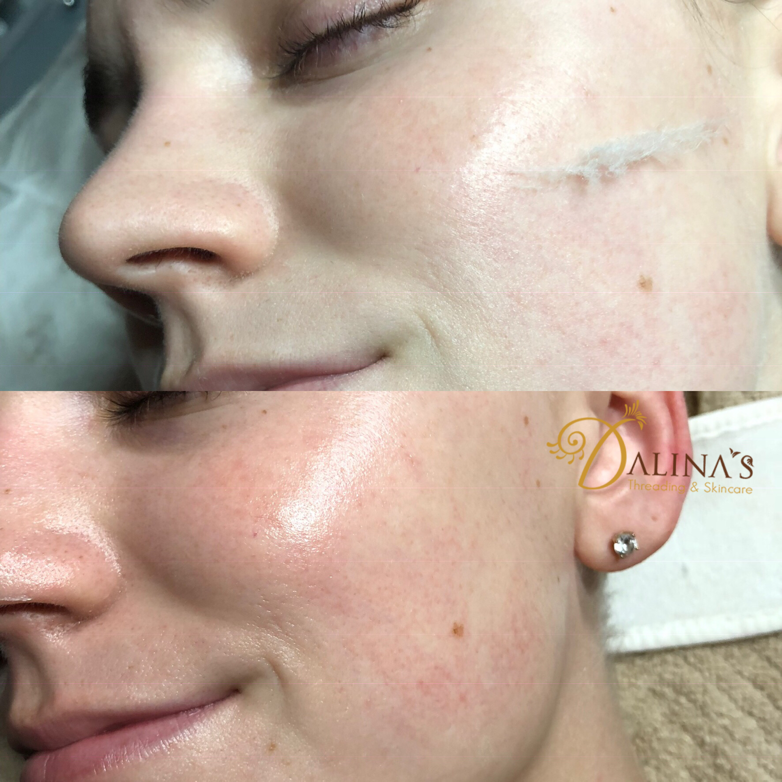 Dermaplaning Treatment — Tucson, AZ — Dalina’s Threading & Skincare