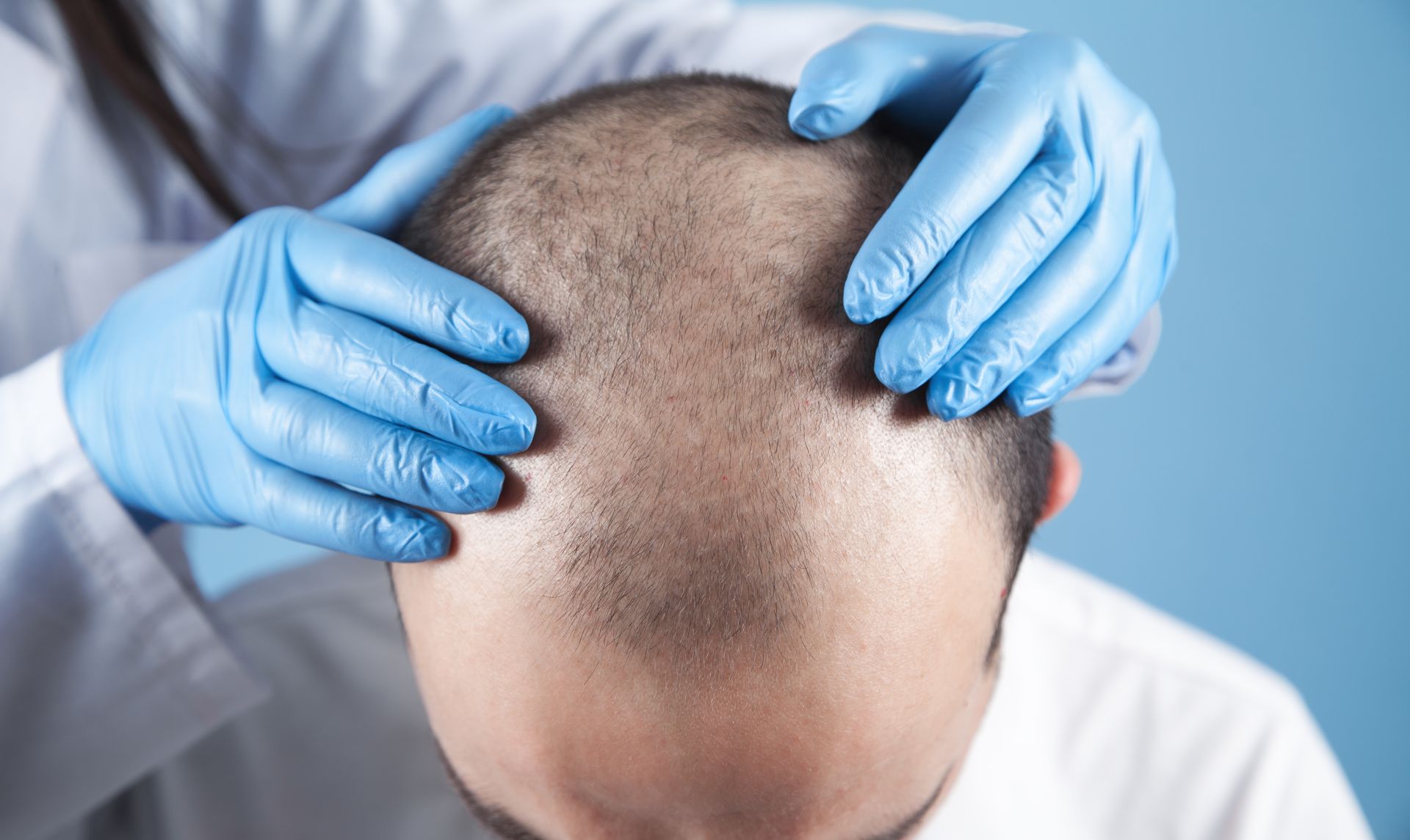 Specialist evaluating hair loss for customized replacement treatment.