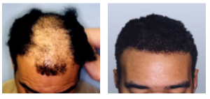 Hair Grew Back — Shelby, MI — Drs. Berry, Tessler & Aronovitz