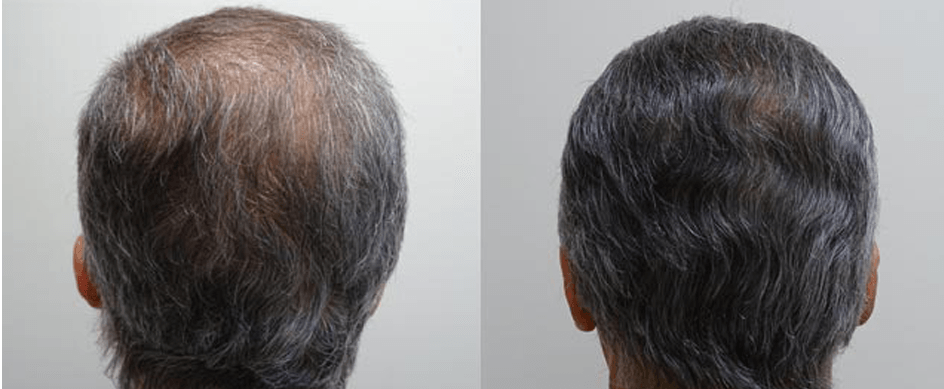 1,610 follicular units — Shelby, MI — Drs. Berry, Tessler & Aronovitz