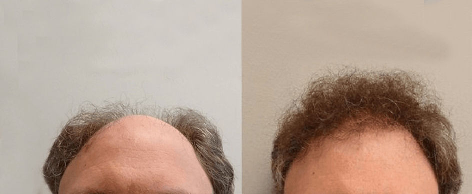 1,610 follicular units top — Shelby, MI — Drs. Berry, Tessler & Aronovitz