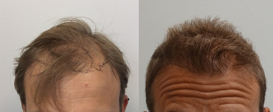 2,531 follicular unit front — Shelby, MI — Drs. Berry, Tessler & Aronovitz