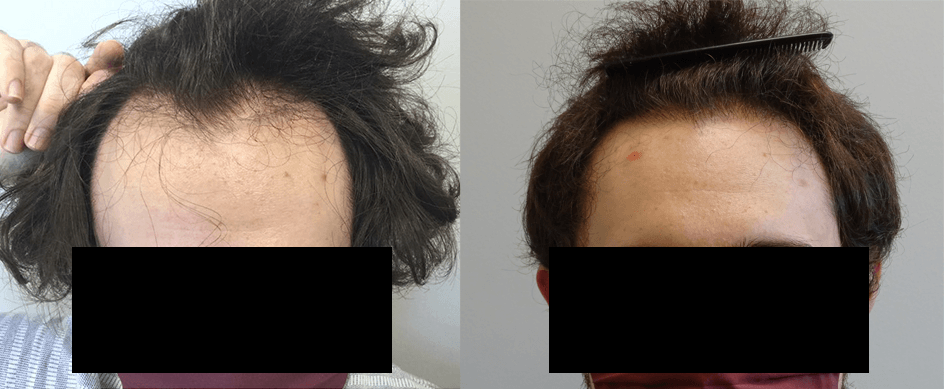 1,850 follicular units — Shelby, MI — Drs. Berry, Tessler & Aronovitz