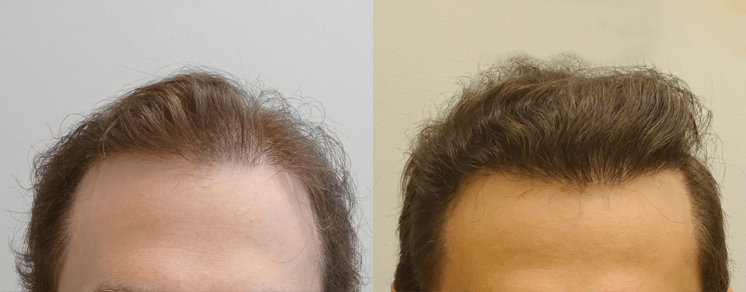 3,200 follicular units front — Shelby, MI — Drs. Berry, Tessler & Aronovitz