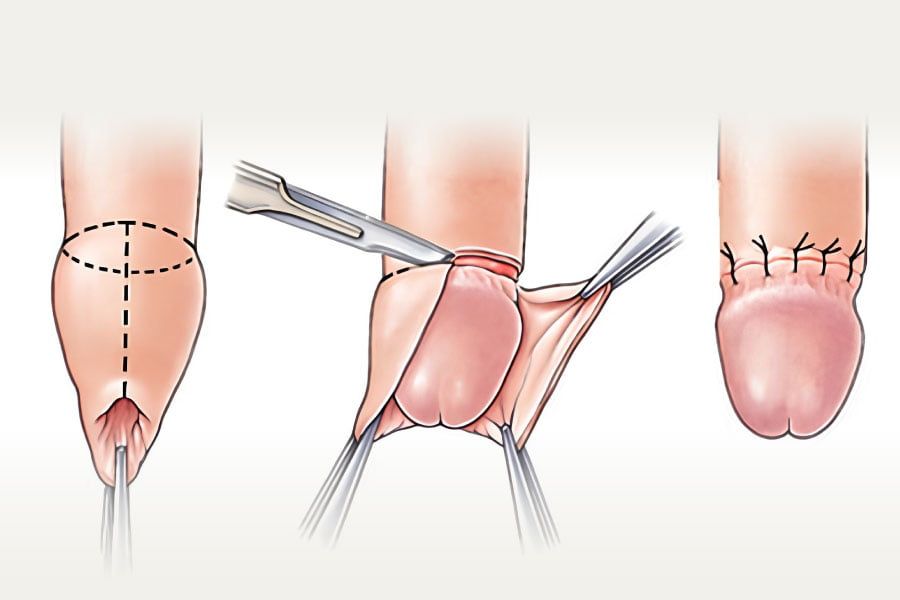Cirurgia de Circuncisão ou Postectomia
