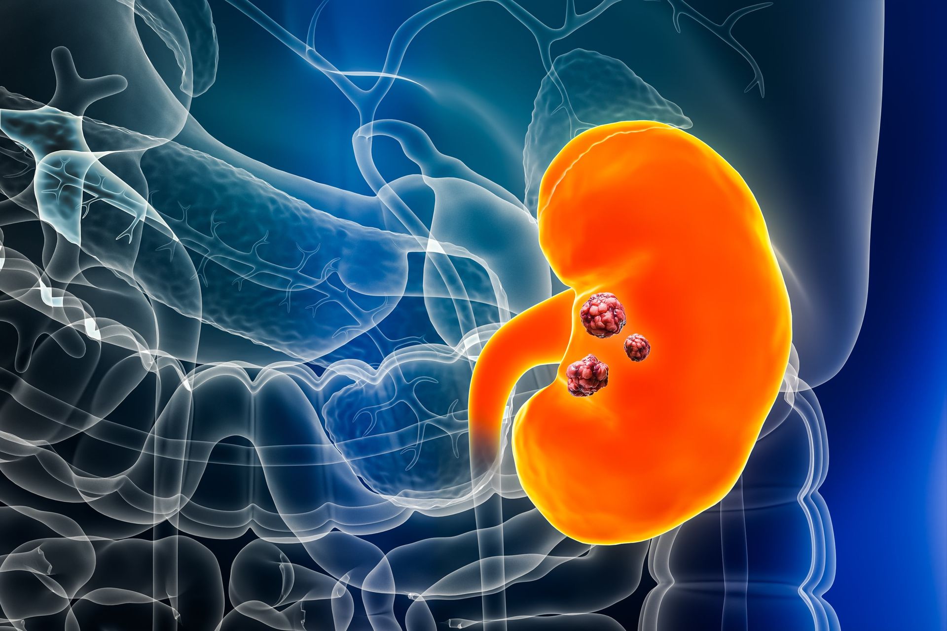 cancer de rim diagnostico e tratamento