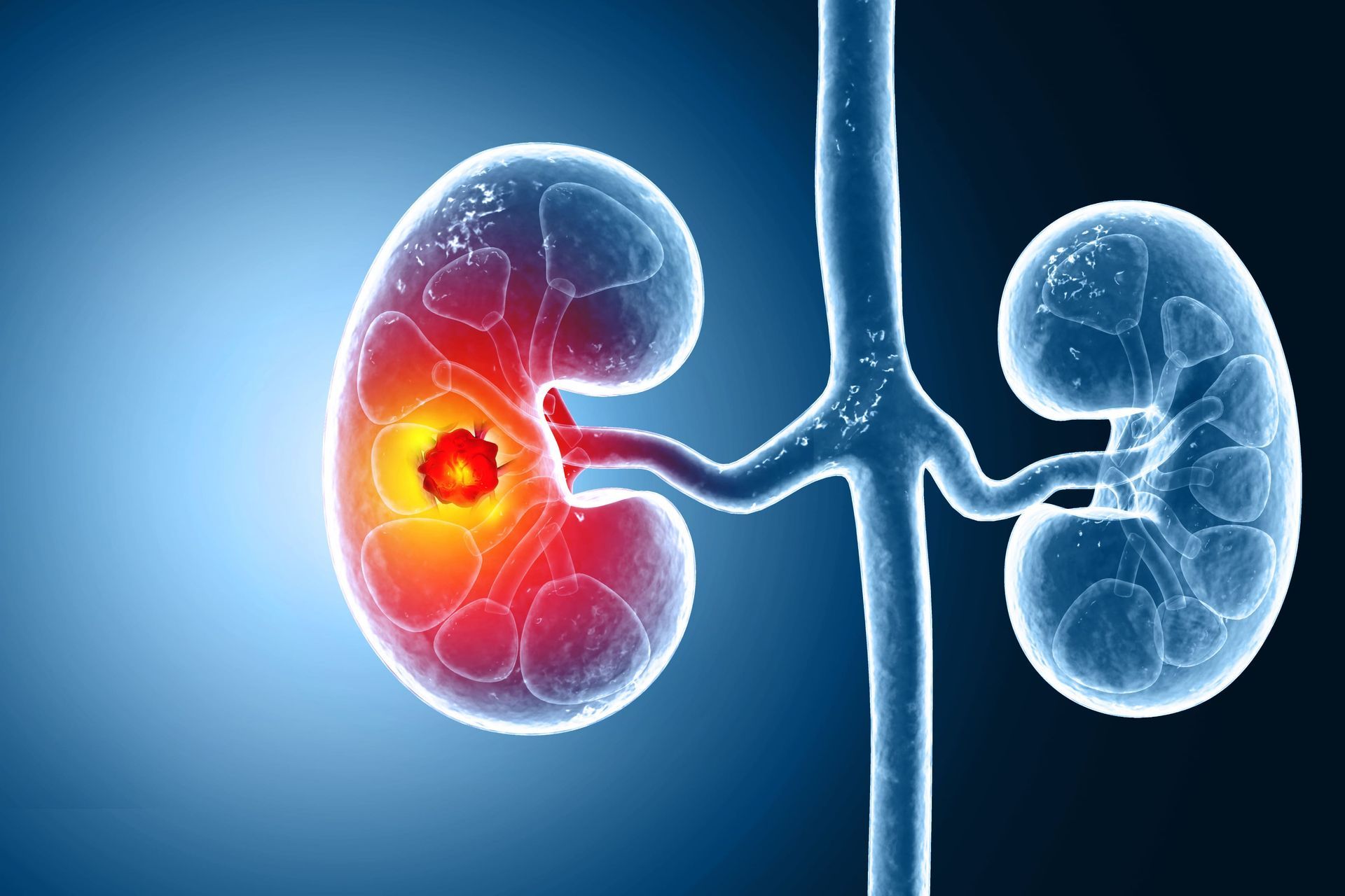 Uma imagem gerada por computador de um rim com um tumor.