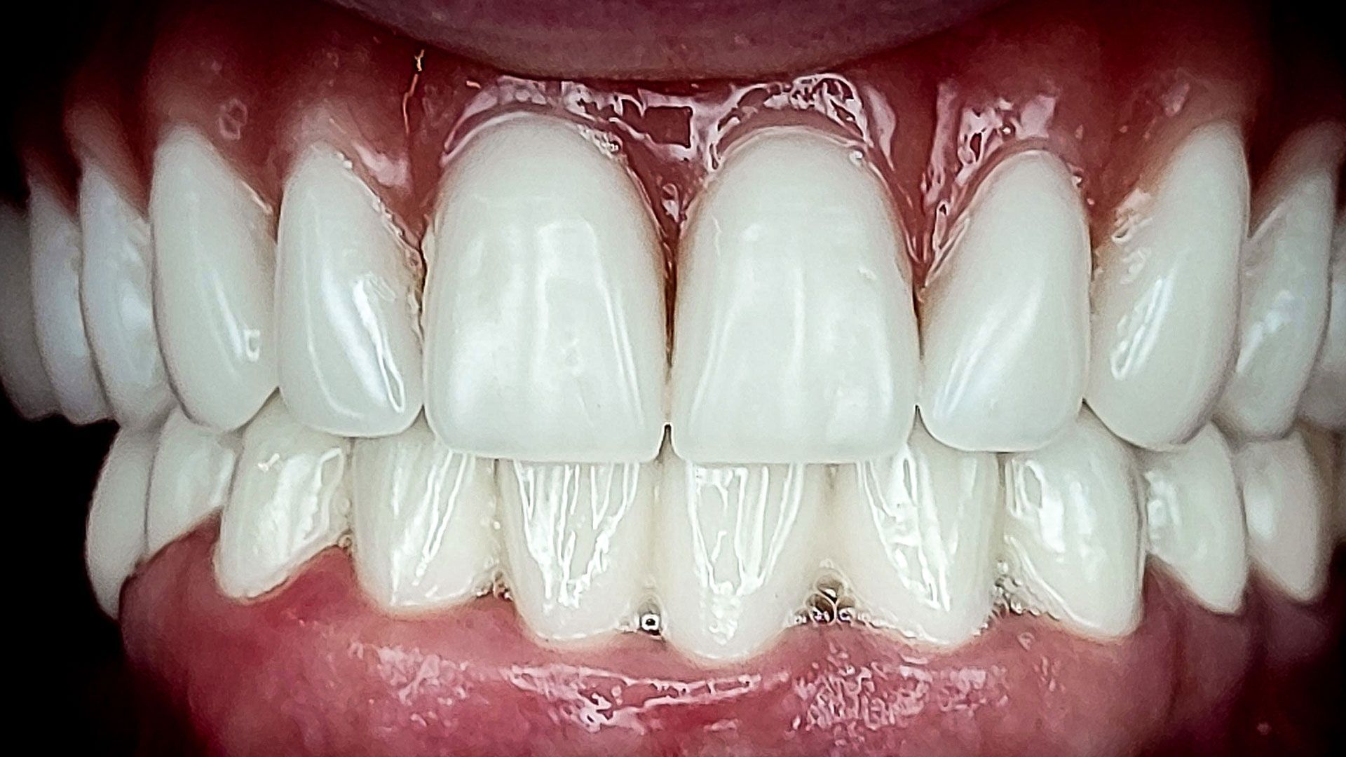 Un primo piano dei denti di una persona con una protesi totale.