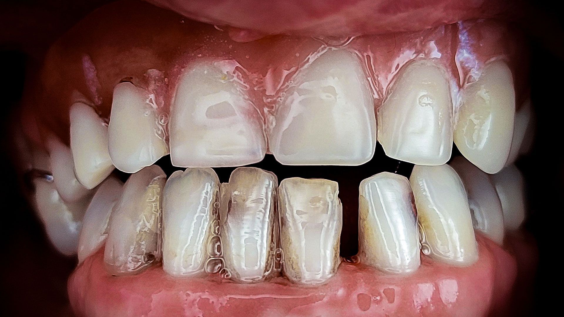 Un primo piano dei denti di una persona con molta placca sopra.