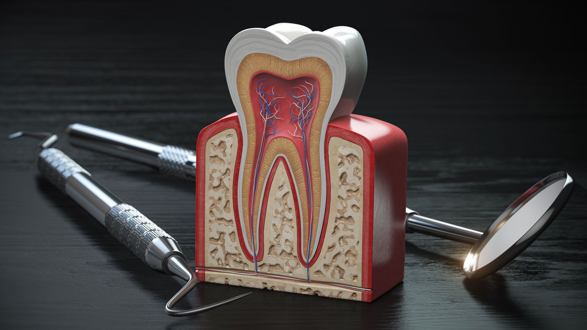Granuloma Dentale