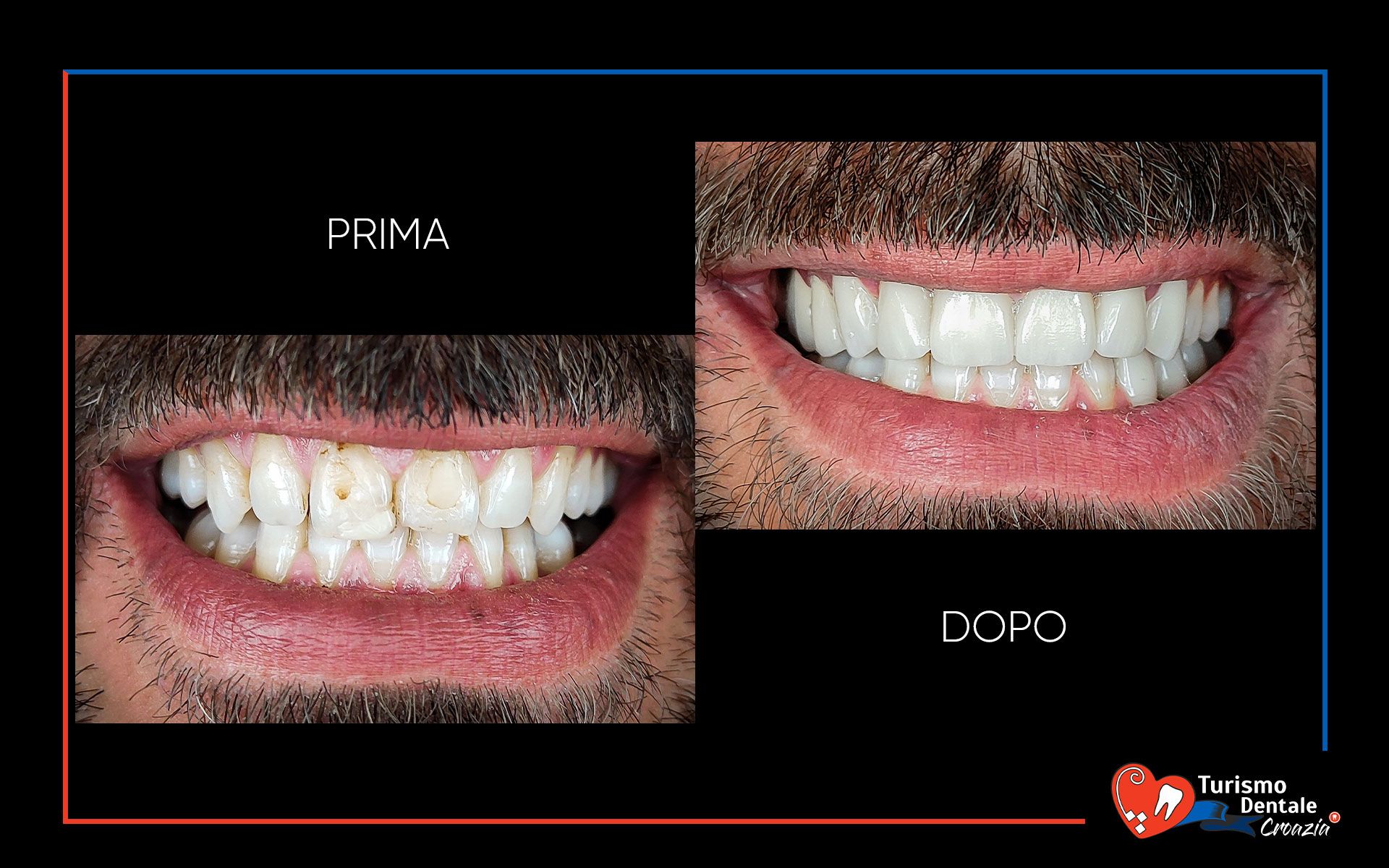 Corone dentali prima e dopo esempio #2