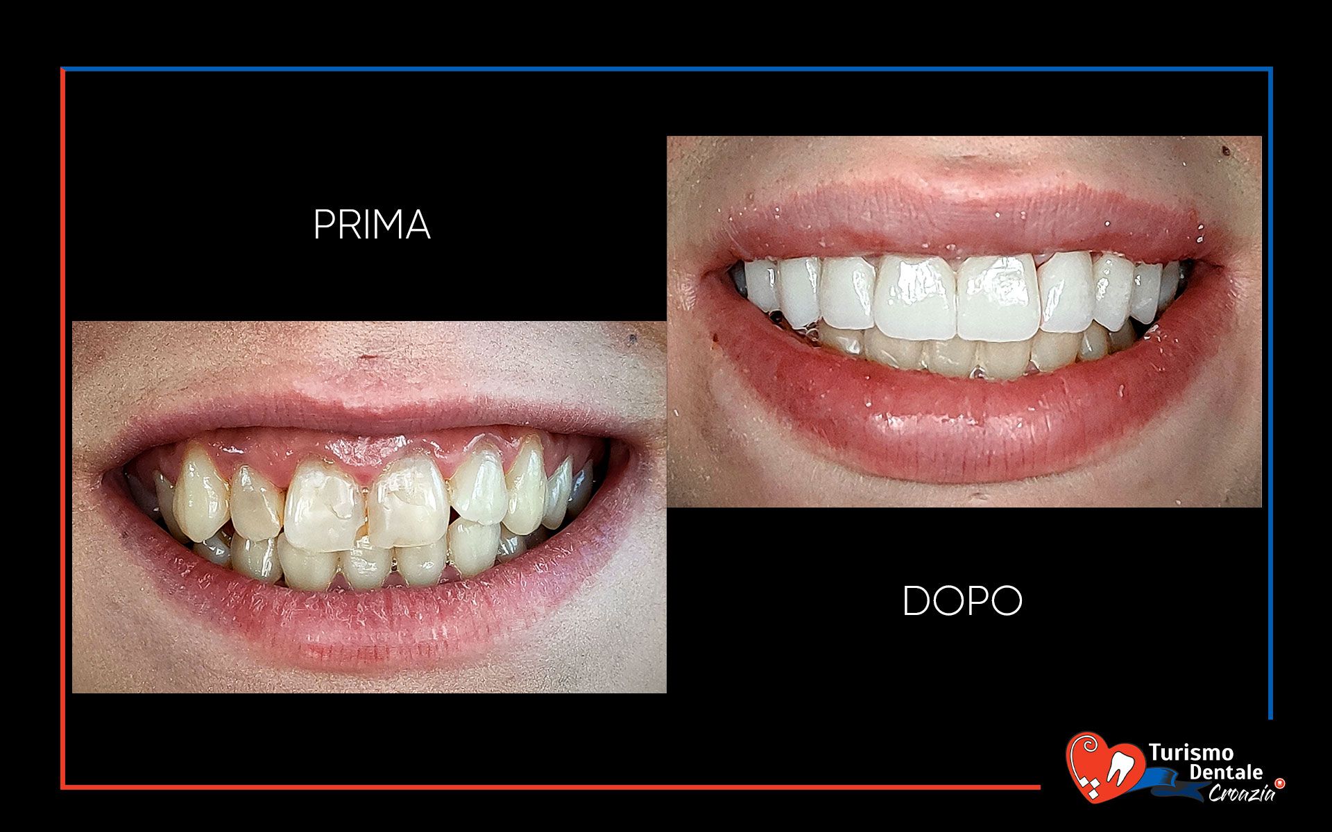 Corone dentali prima e dopo esempio #3
