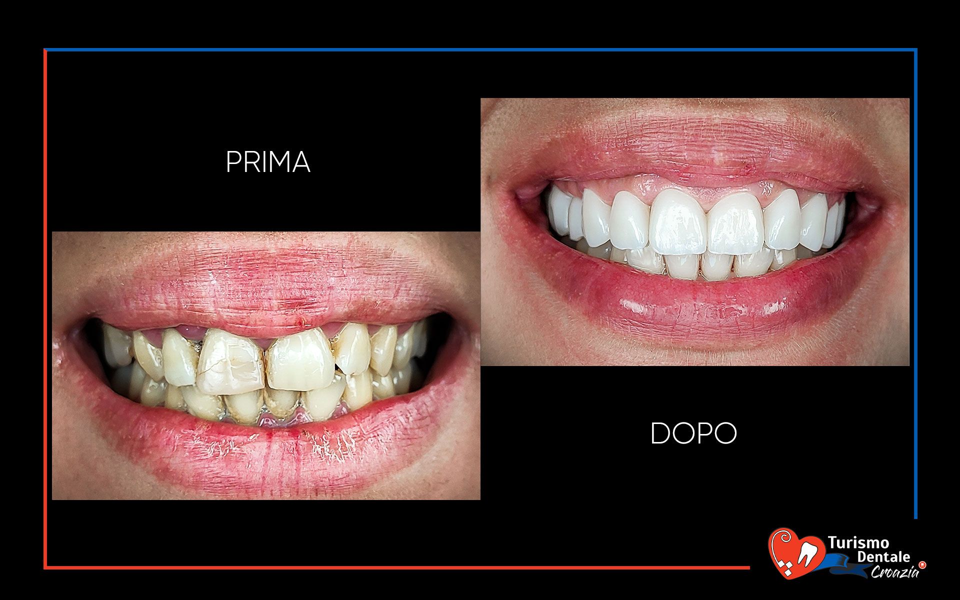 Corone dentali prima e dopo esempio #5