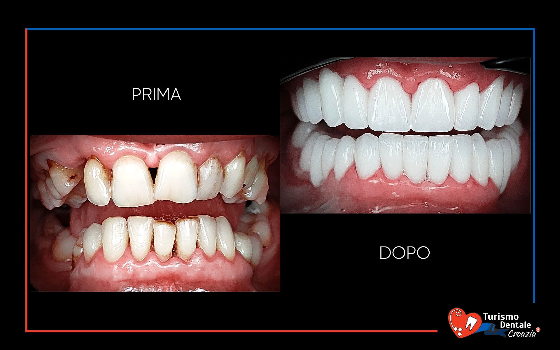 Corone dentali prima e dopo esempio #6