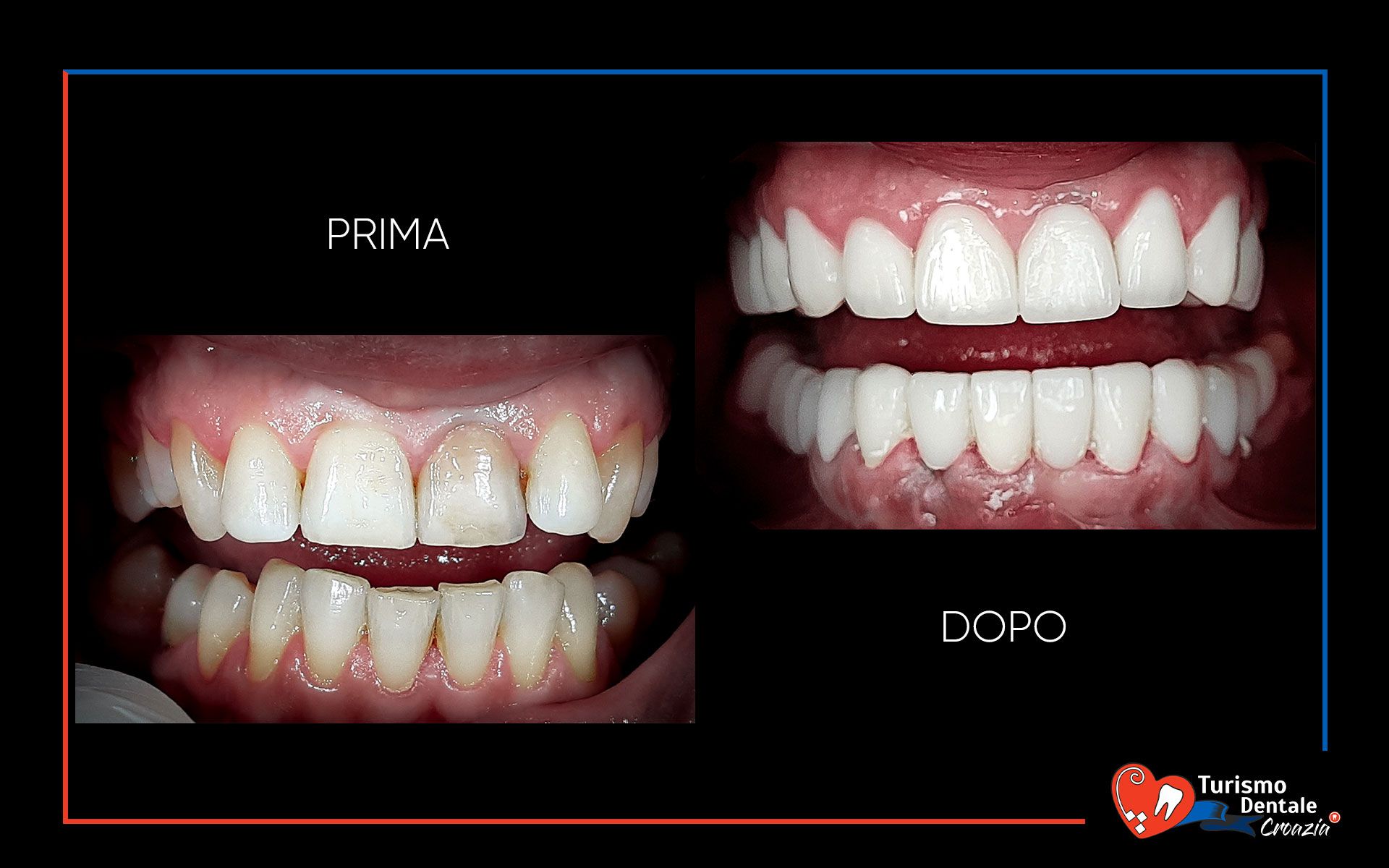 Corone dentali prima e dopo esempio #4
