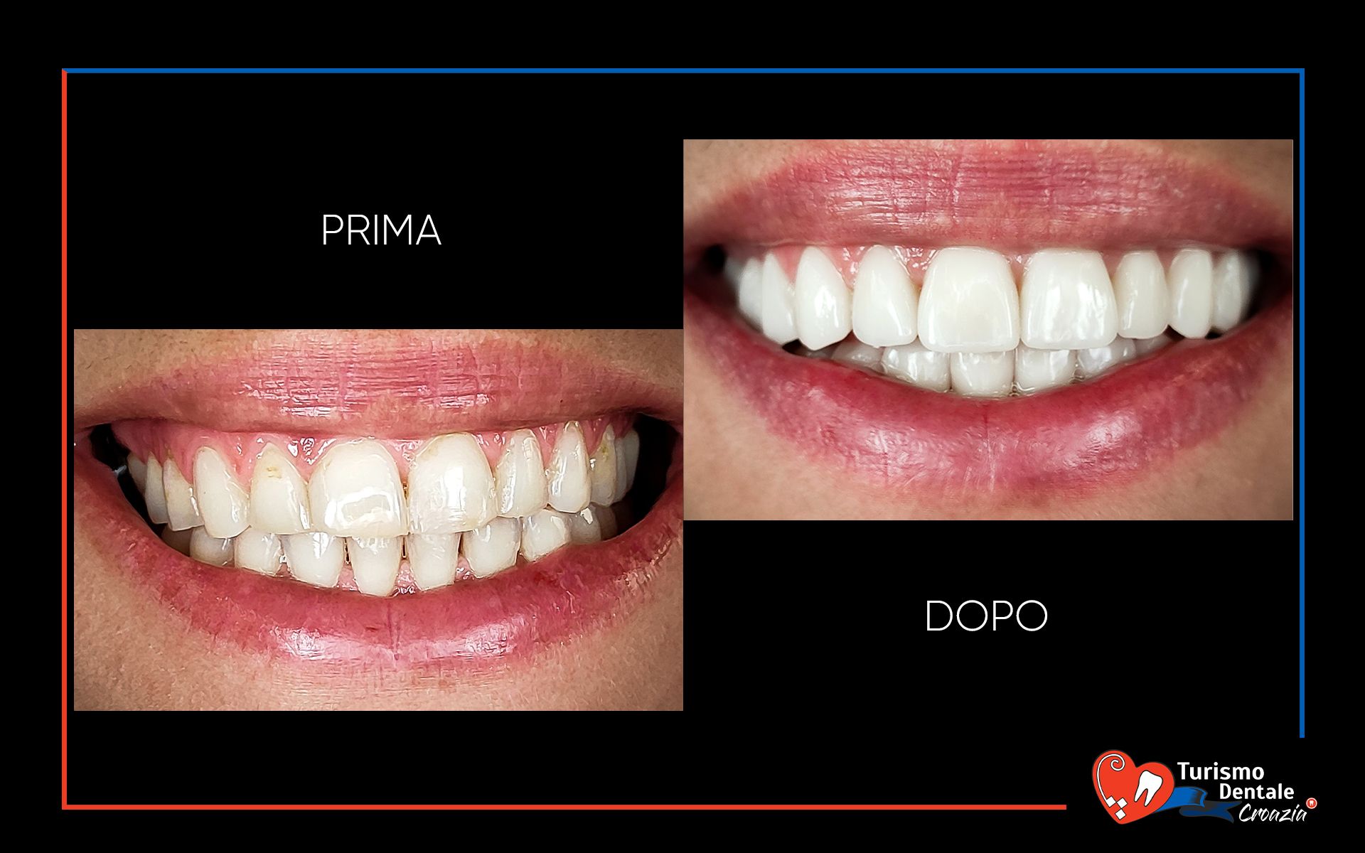 Faccette dentali prima e dopo esempio #3