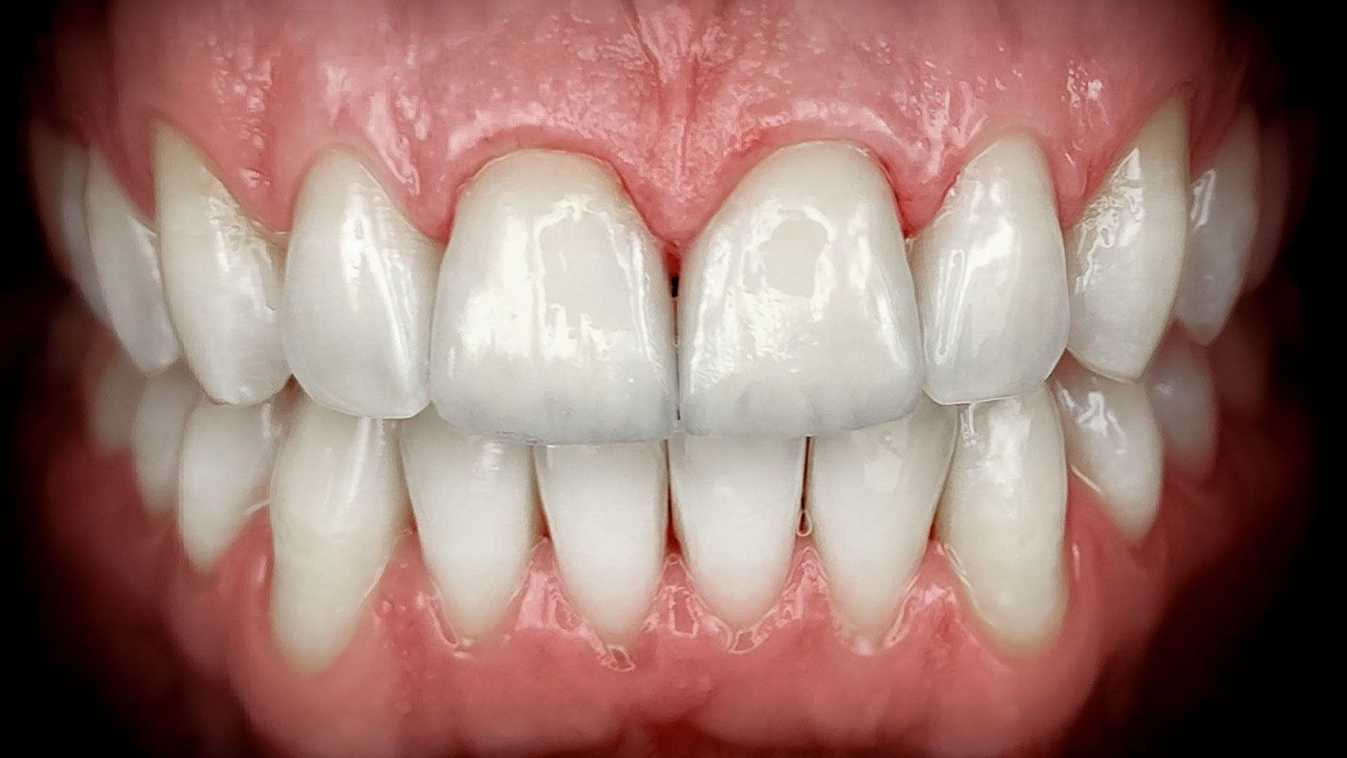 Faccette dentali black friday -20% - dopo