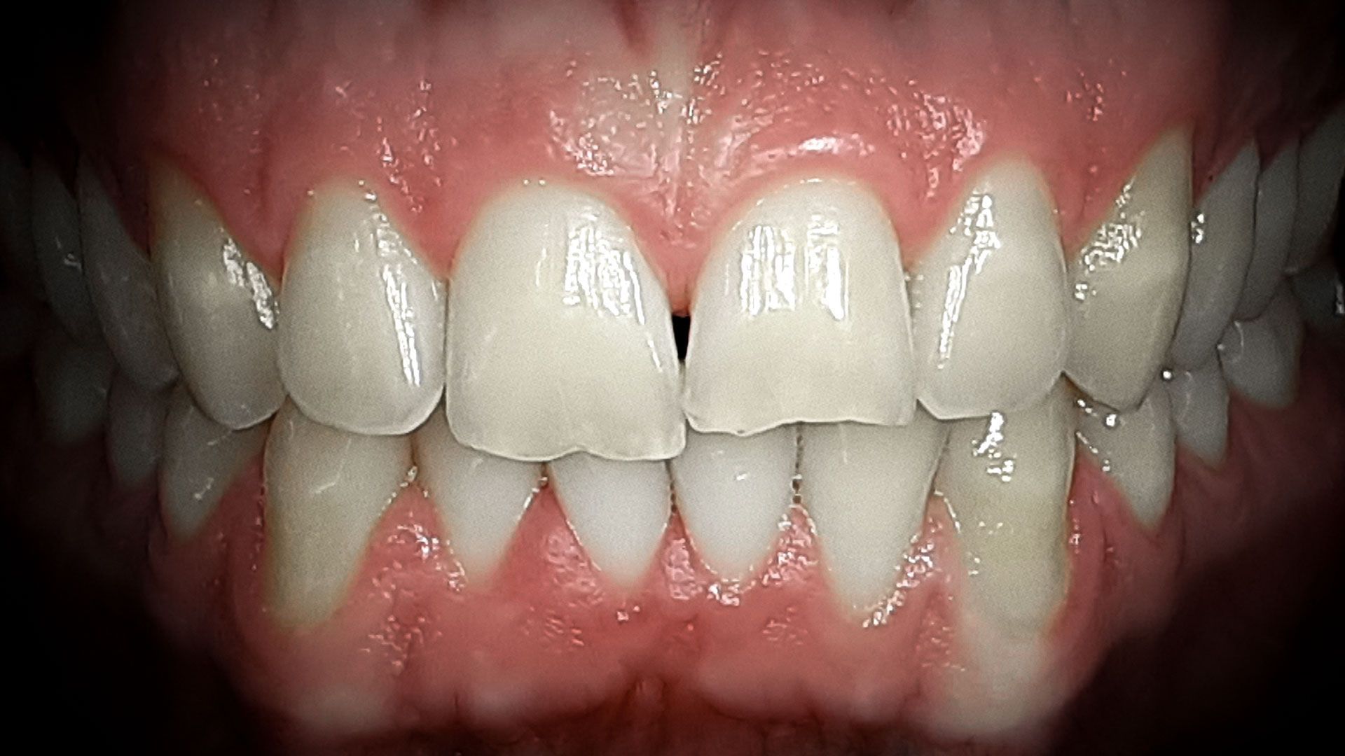 Faccette dentali black friday -20% -prima