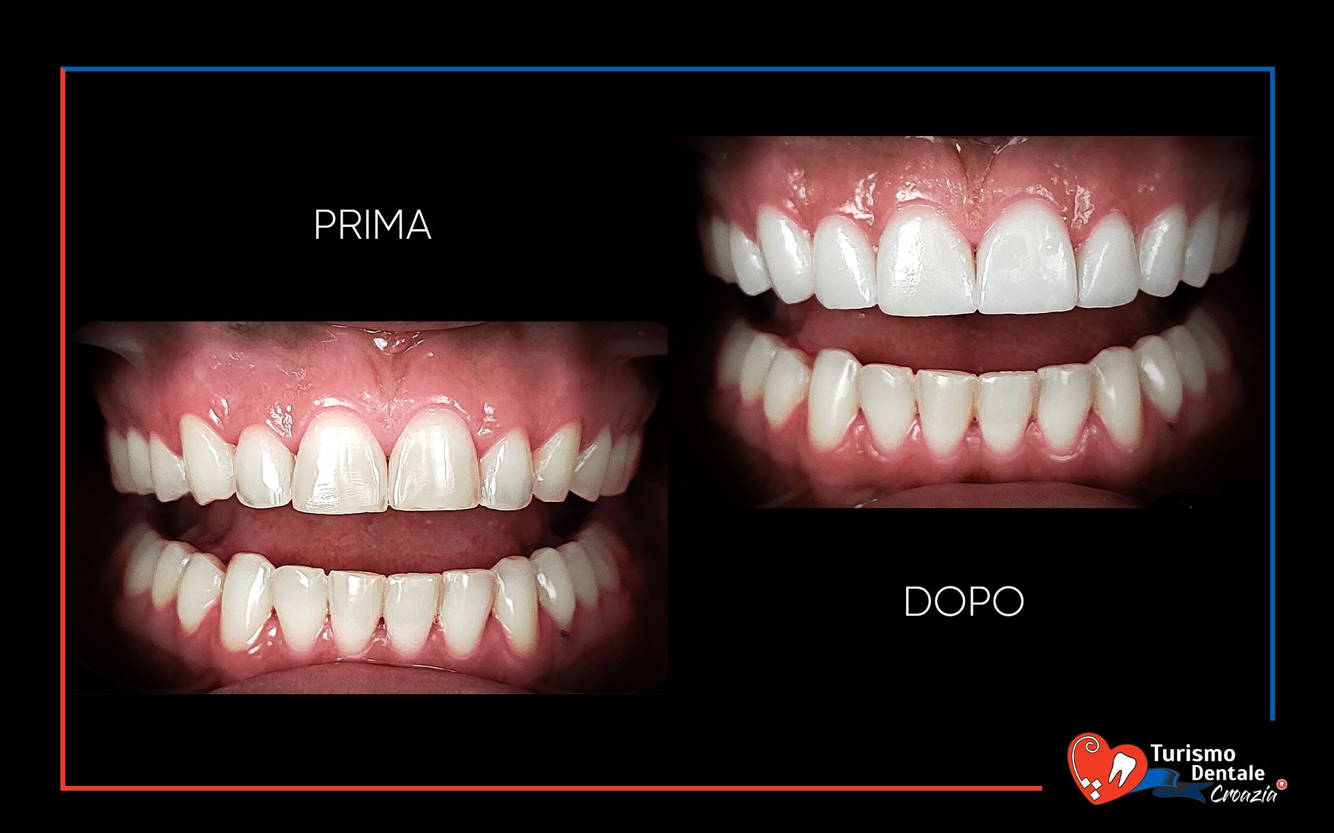 Faccette dentali prima e dopo esempio #2