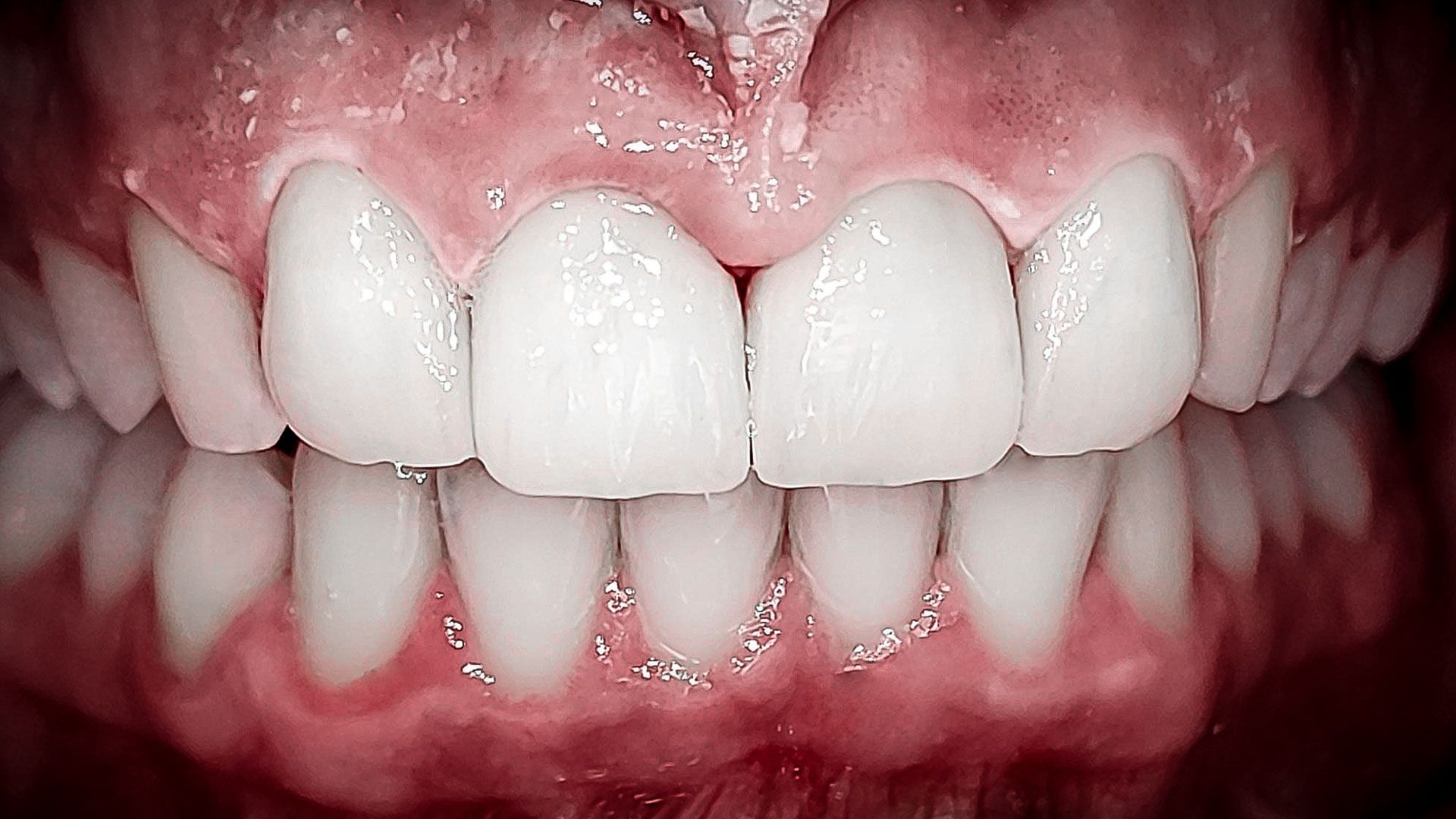 Faccette dentali in turismo dentale croazia - dopo