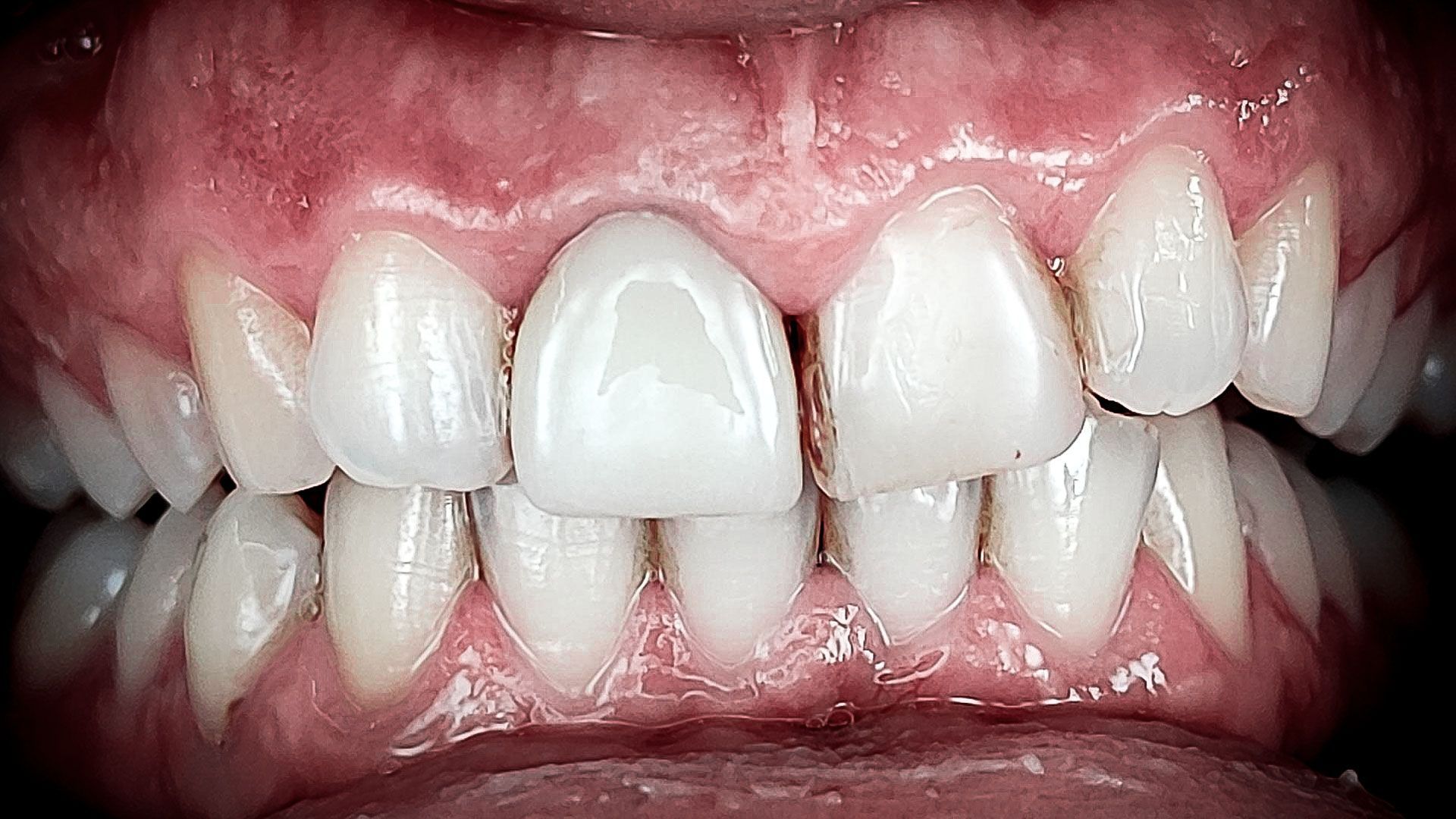 Faccette dentali in turismo dentale croazia - prima