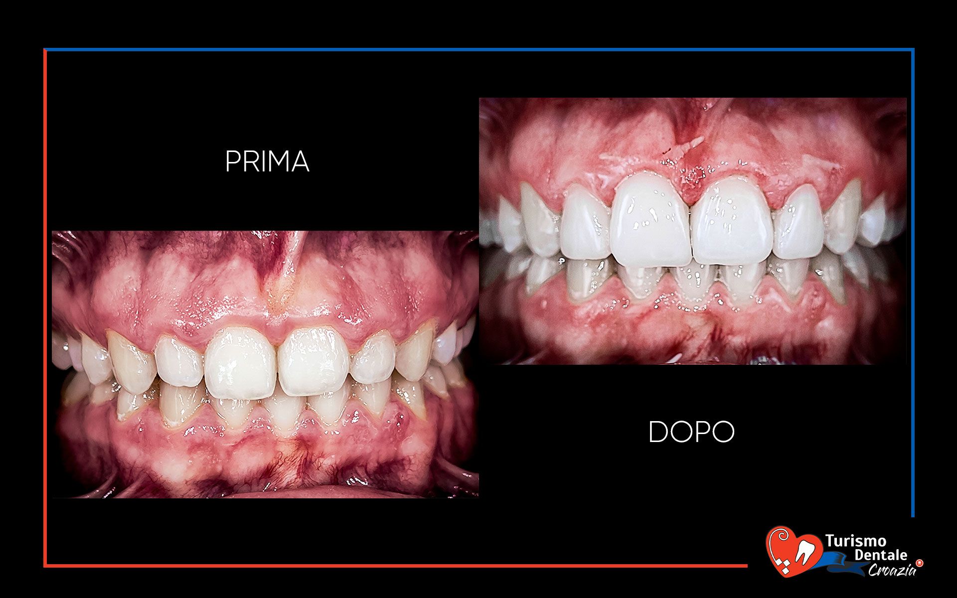 Faccette dentali prima e dopo esempio #4