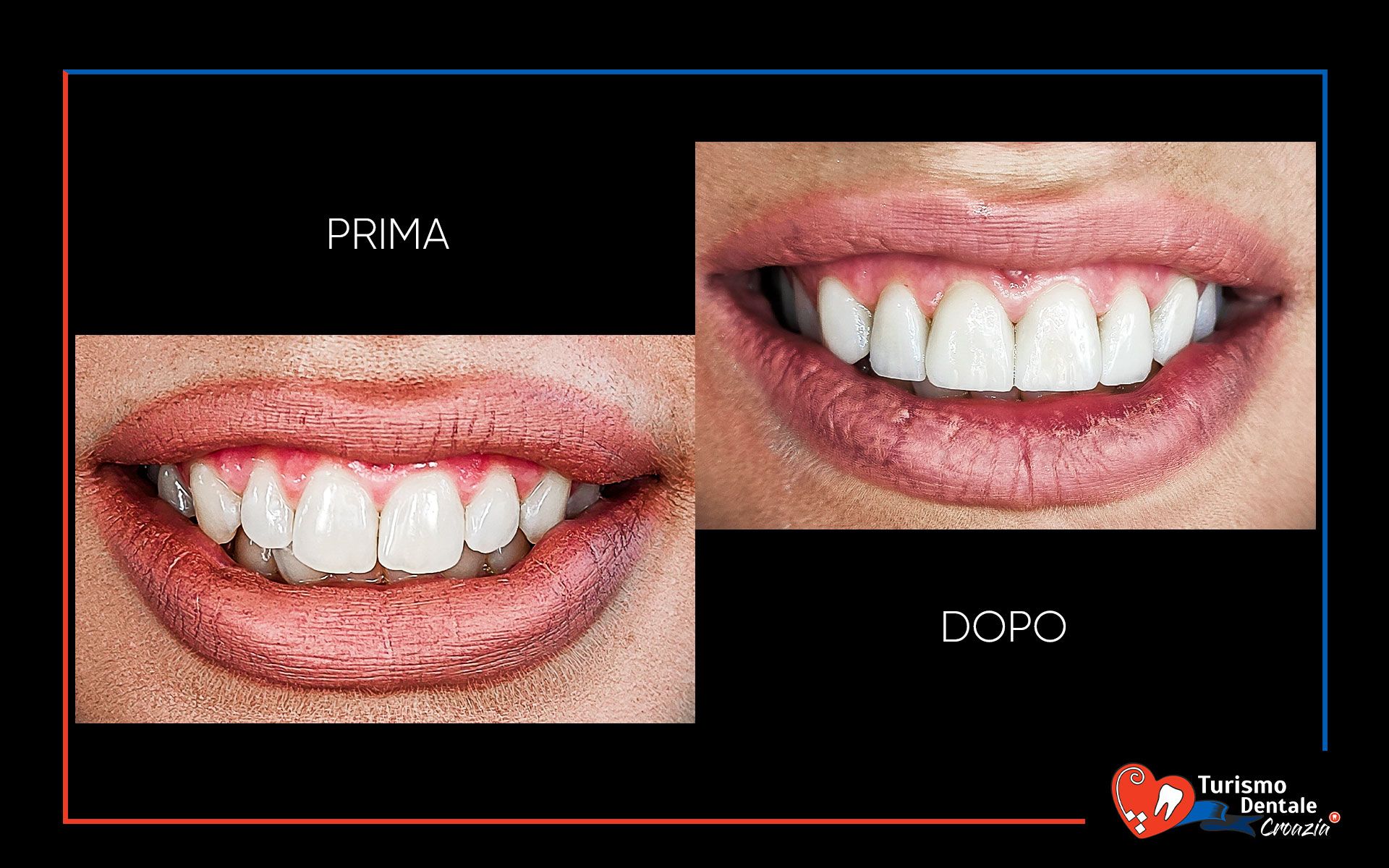 Faccette dentali prima e dopo esempio #1