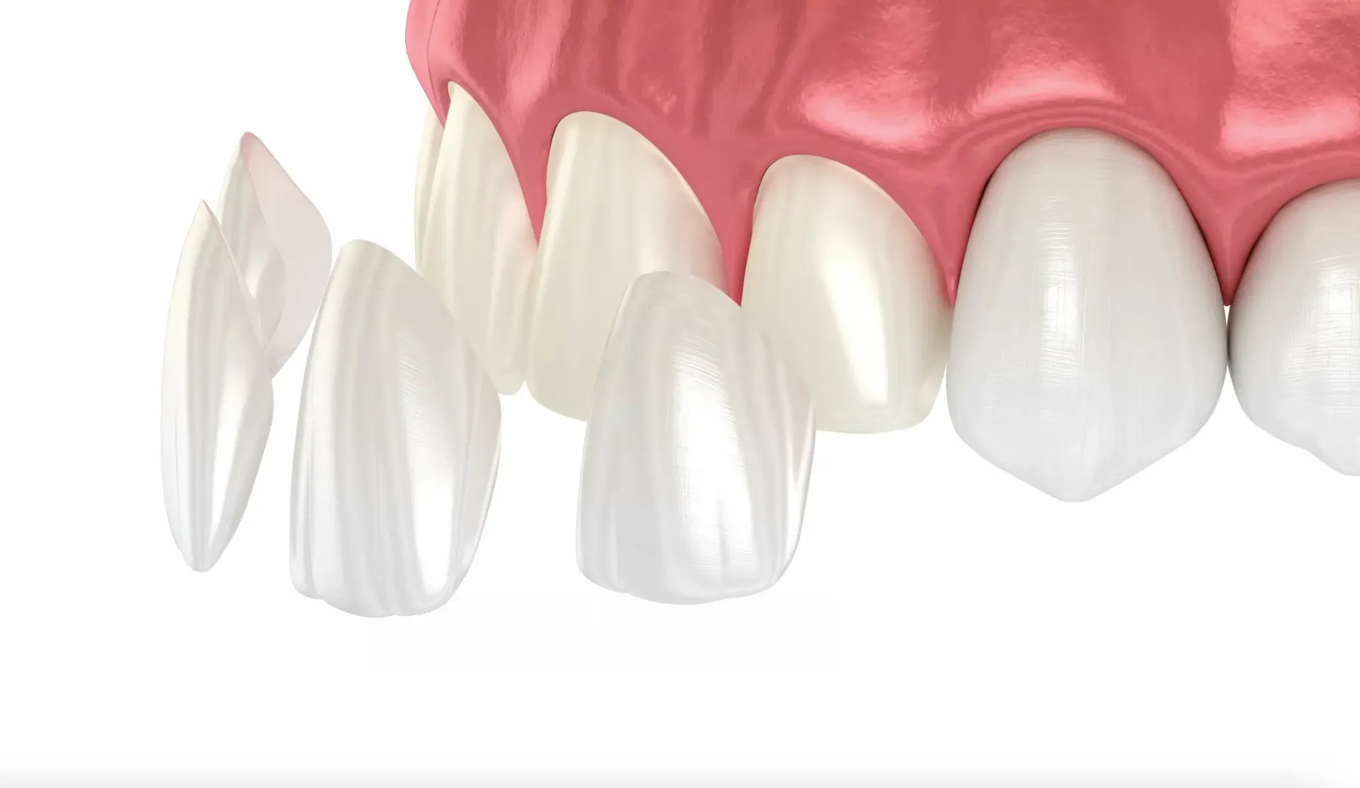 Faccette dentali pro e contro
