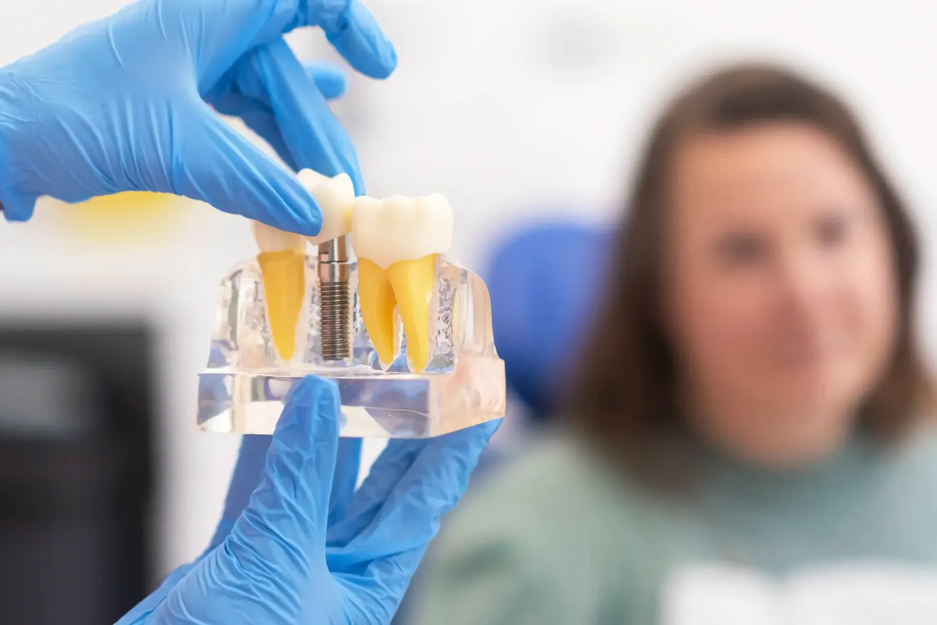 Impianto Dentale a Carico Immediato