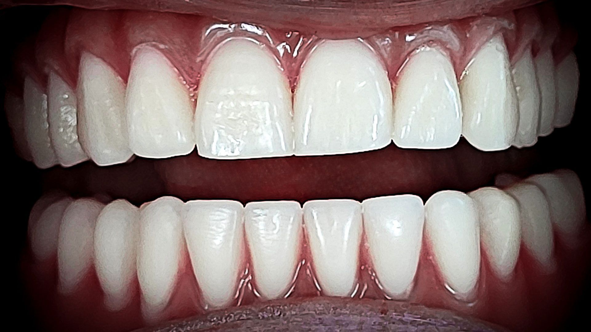Un primo piano dei denti di una persona con una protesi totale.