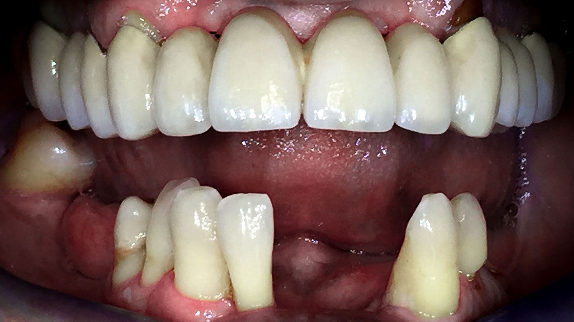 Un primo piano dei denti di una persona con molta placca sopra.
