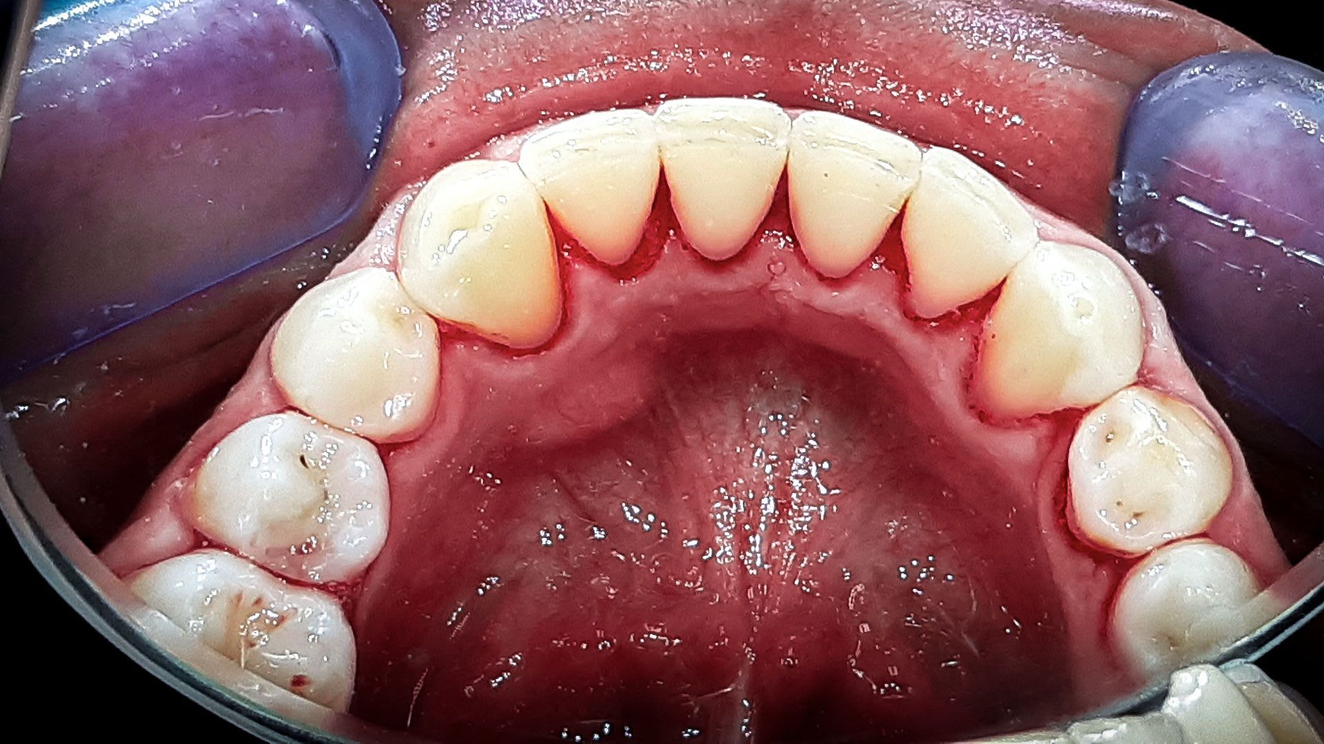 Perché è importante la pulizia del tartaro e la sabbiatura dei denti - dopo.jpg