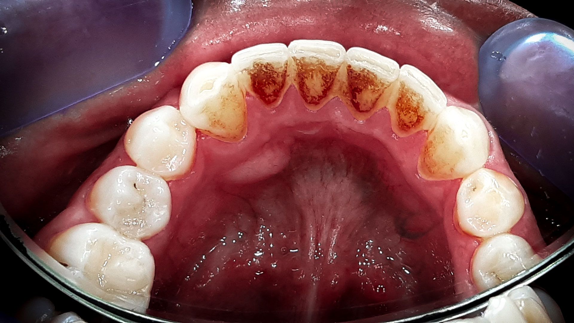 Perché è importante la pulizia del tartaro e la sabbiatura dei denti - prima.jpg