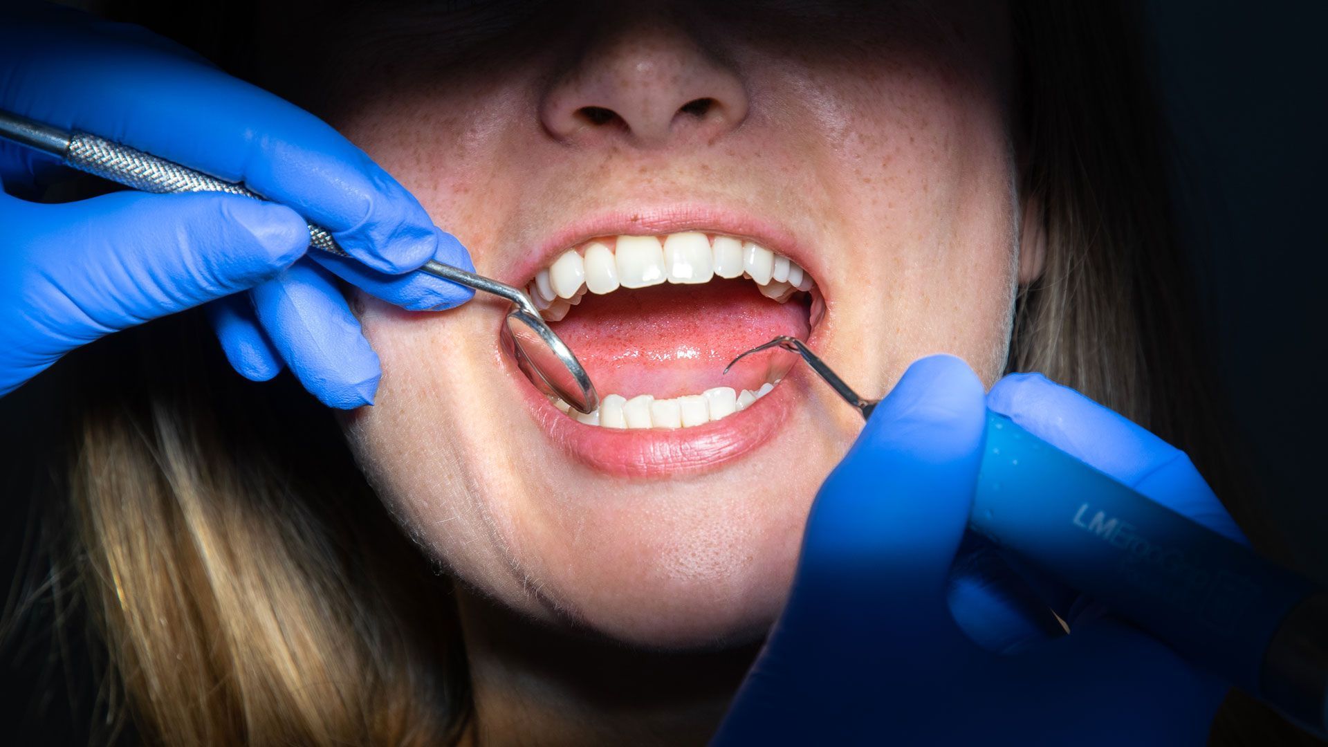 Pulizia del tartaro e sabbiatura dei denti: strumenti e procedure per una pulizia dentale efficace.