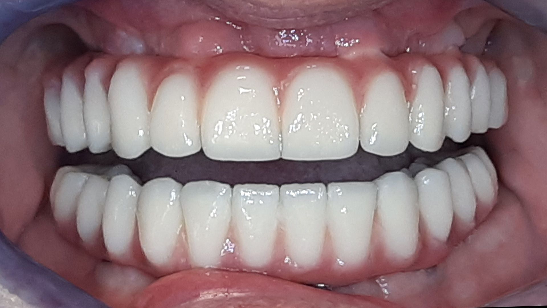 Un primo piano dei denti di una persona con i denti bianchi.