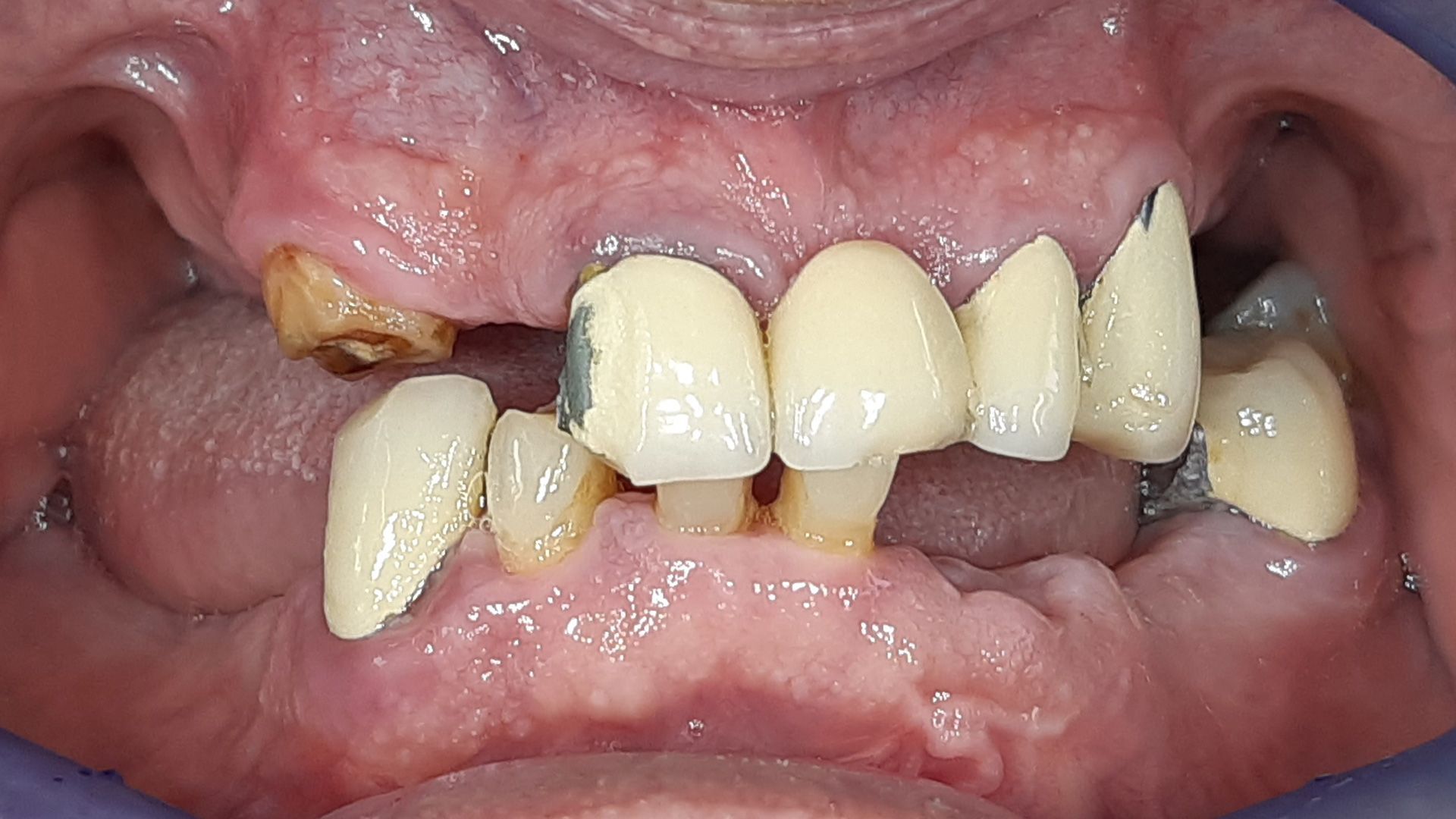 Un primo piano della bocca di una persona con i denti mancanti.