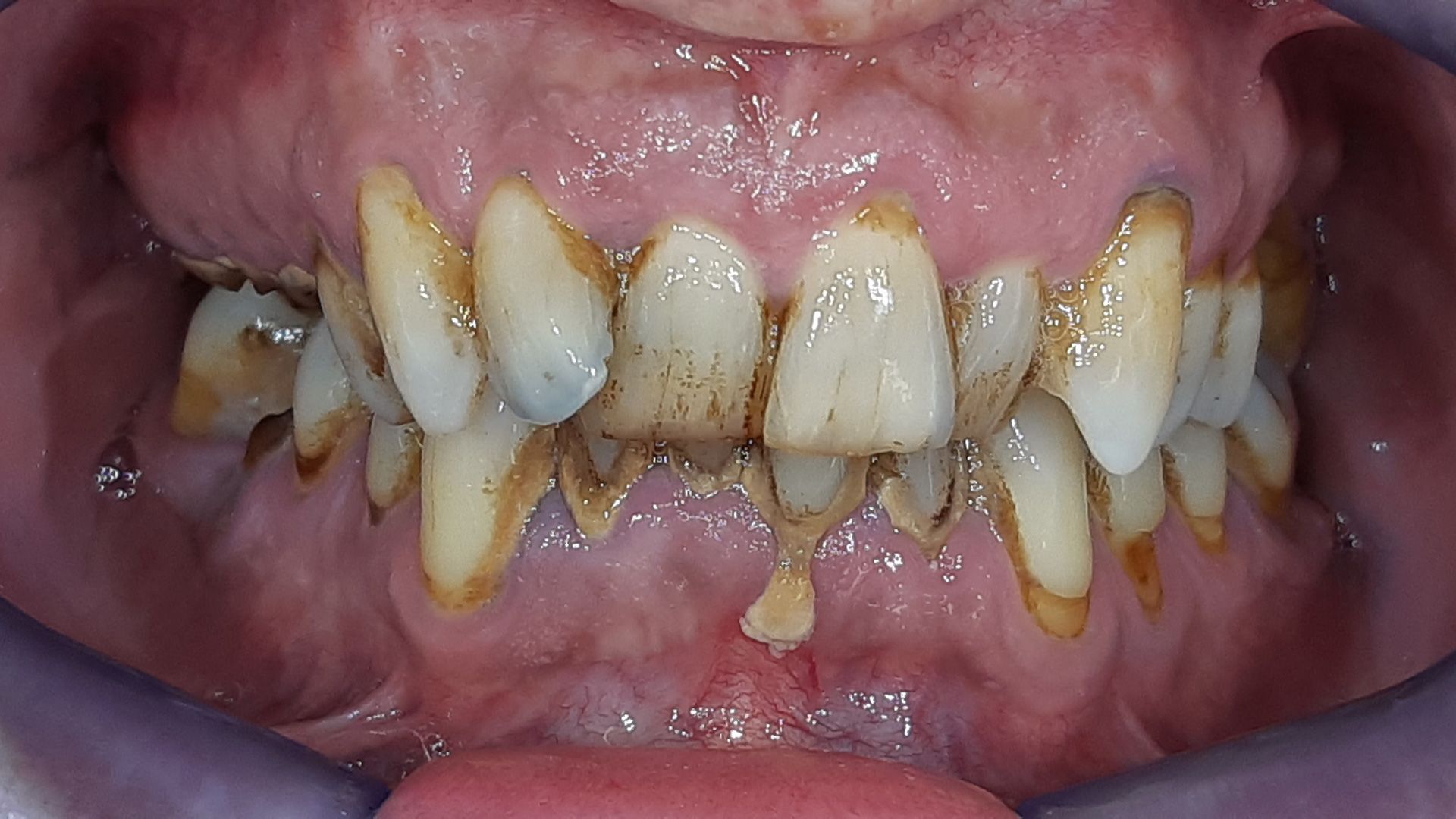 Un primo piano dei denti di una persona con molta placca sopra.
