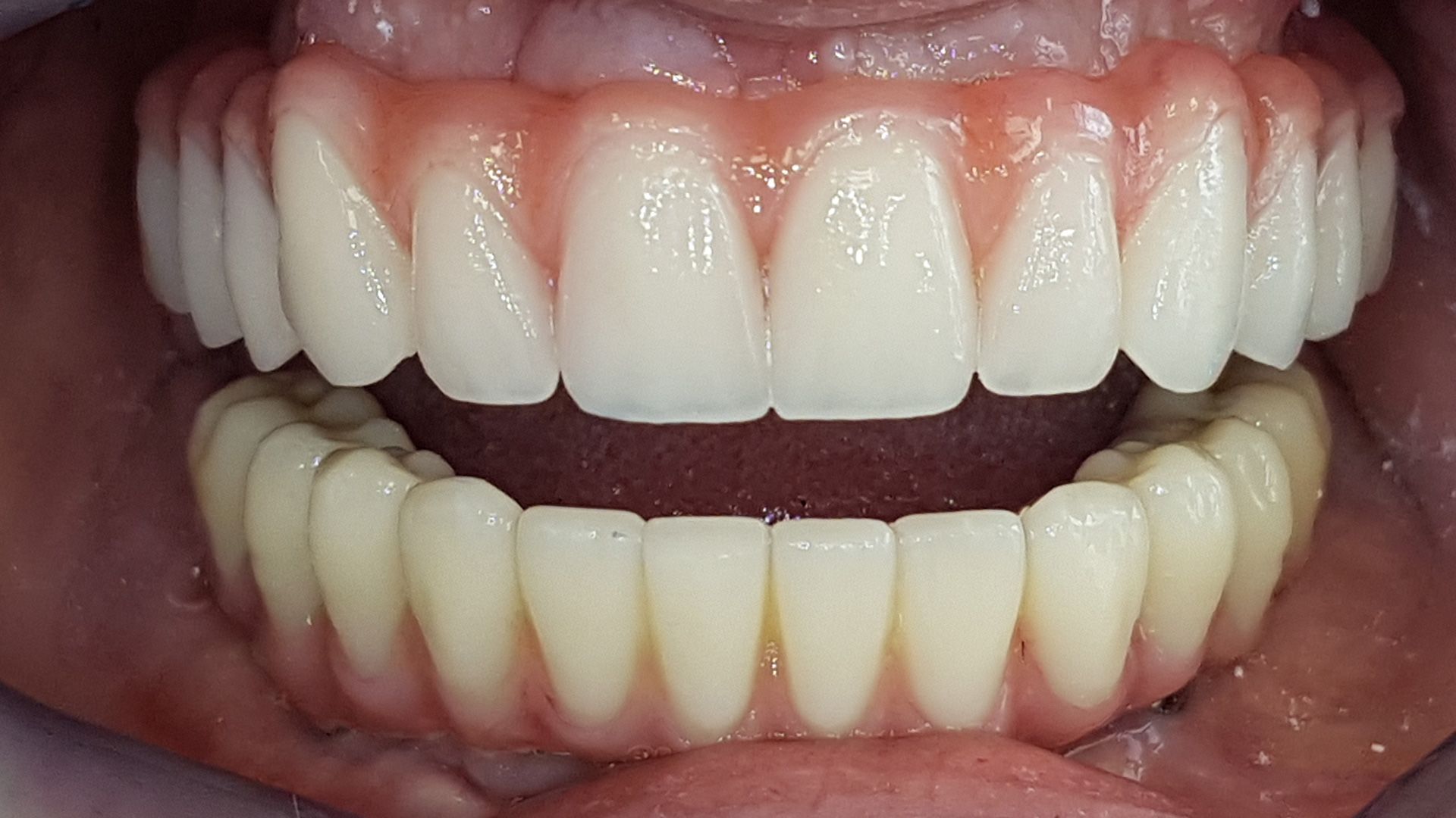 Un primo piano dei denti di una persona con una protesi totale.
