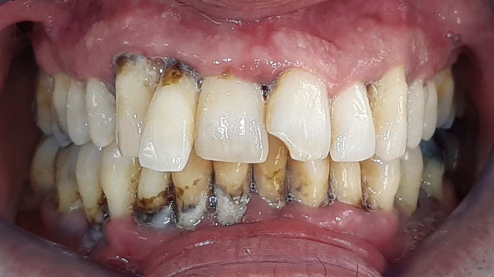 Un primo piano dei denti di una persona con molta placca sopra.