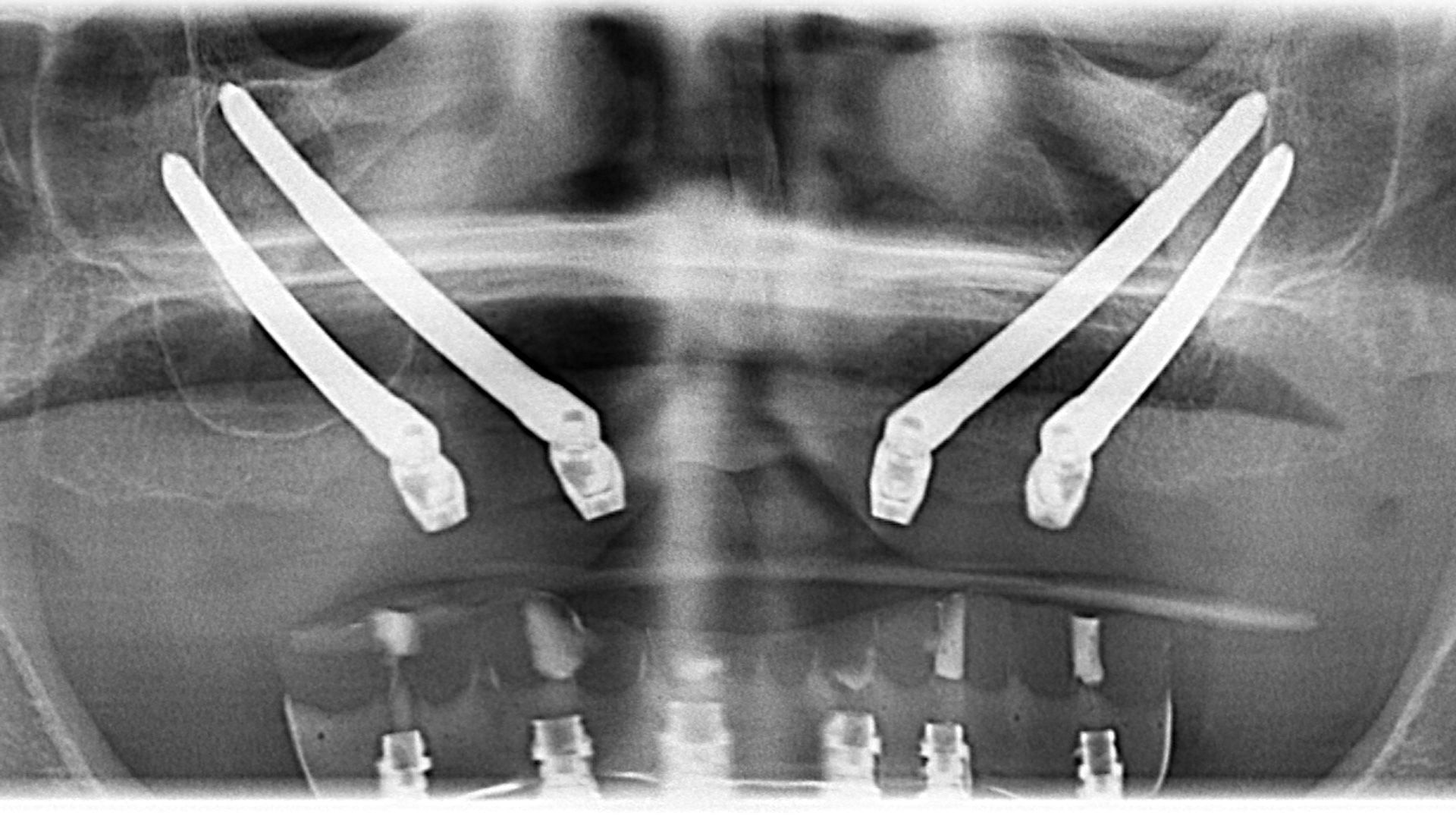 Una radiografia in bianco e nero del volto di una persona con l'apparecchio ortodontico.