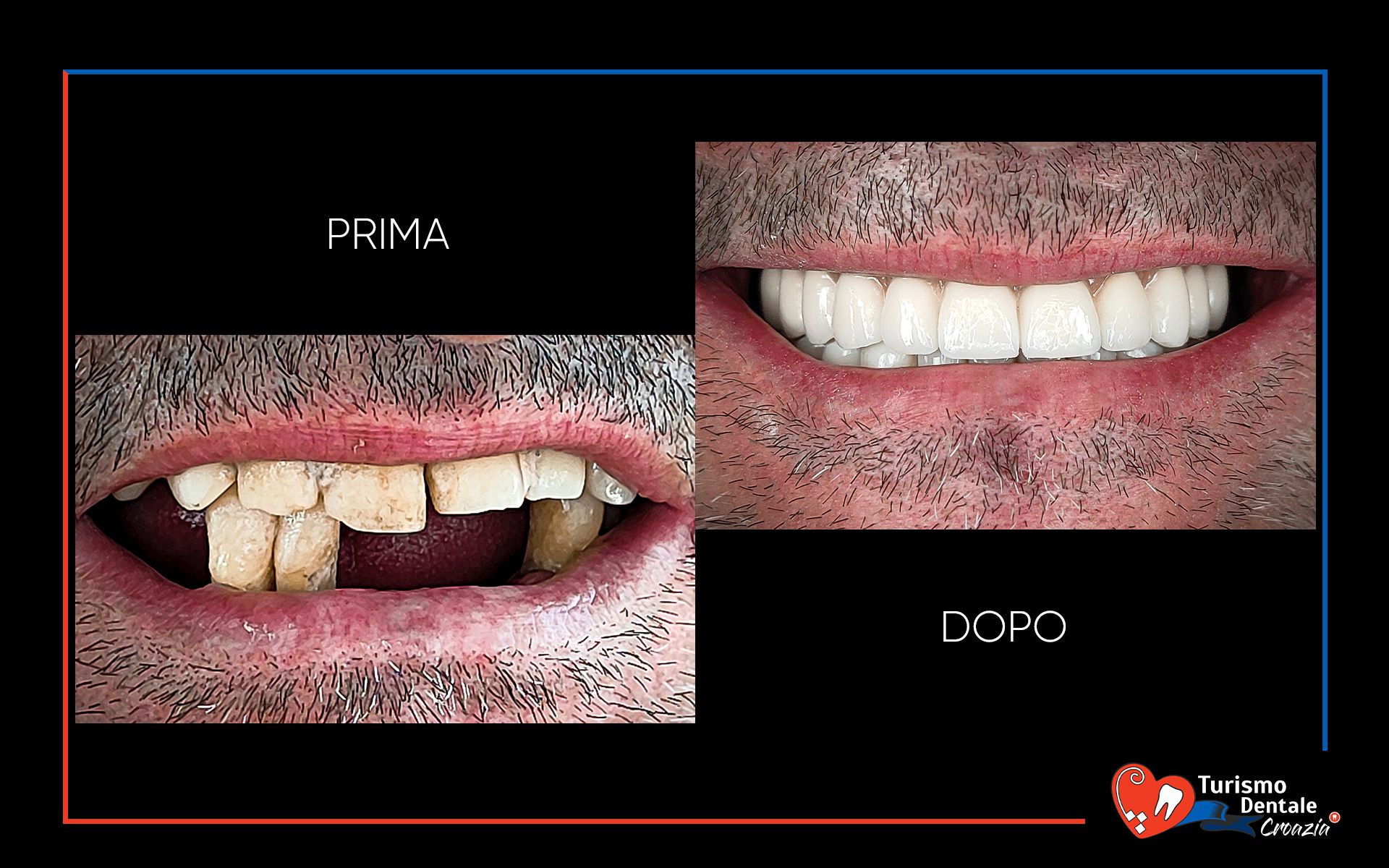 Allon4, Allon5, Allon6 prima e dopo esempio #4