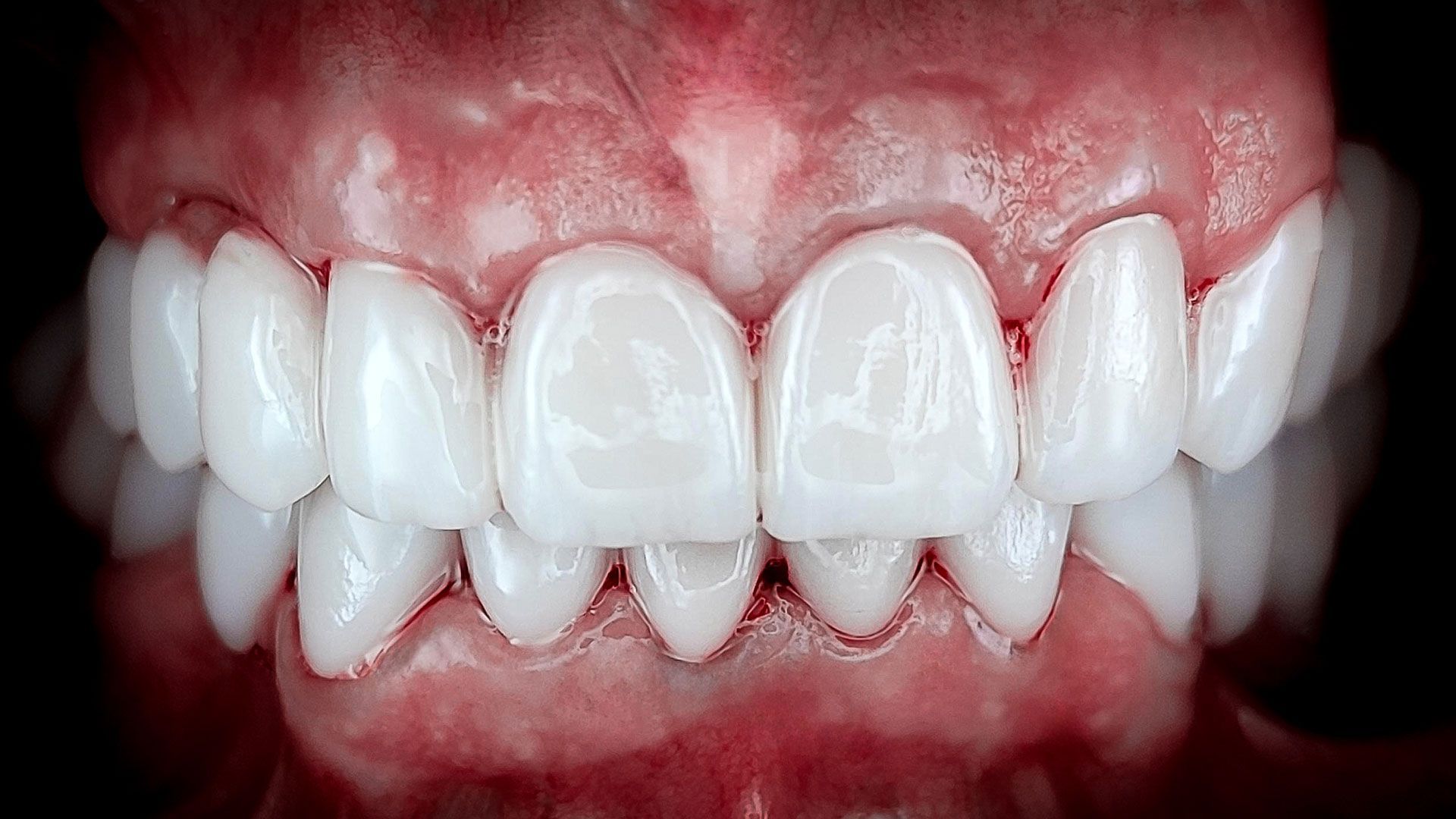 Un primo piano dei denti di una persona con una protesi totale.