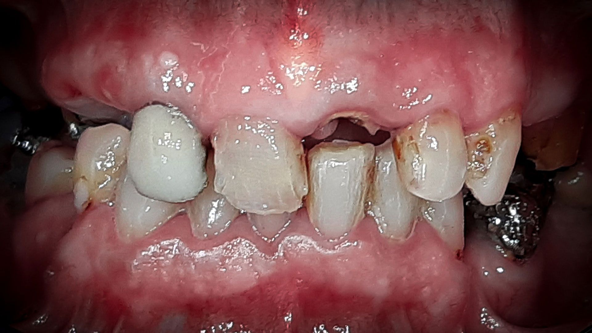 Un primo piano dei denti di una persona con molta placca sopra.