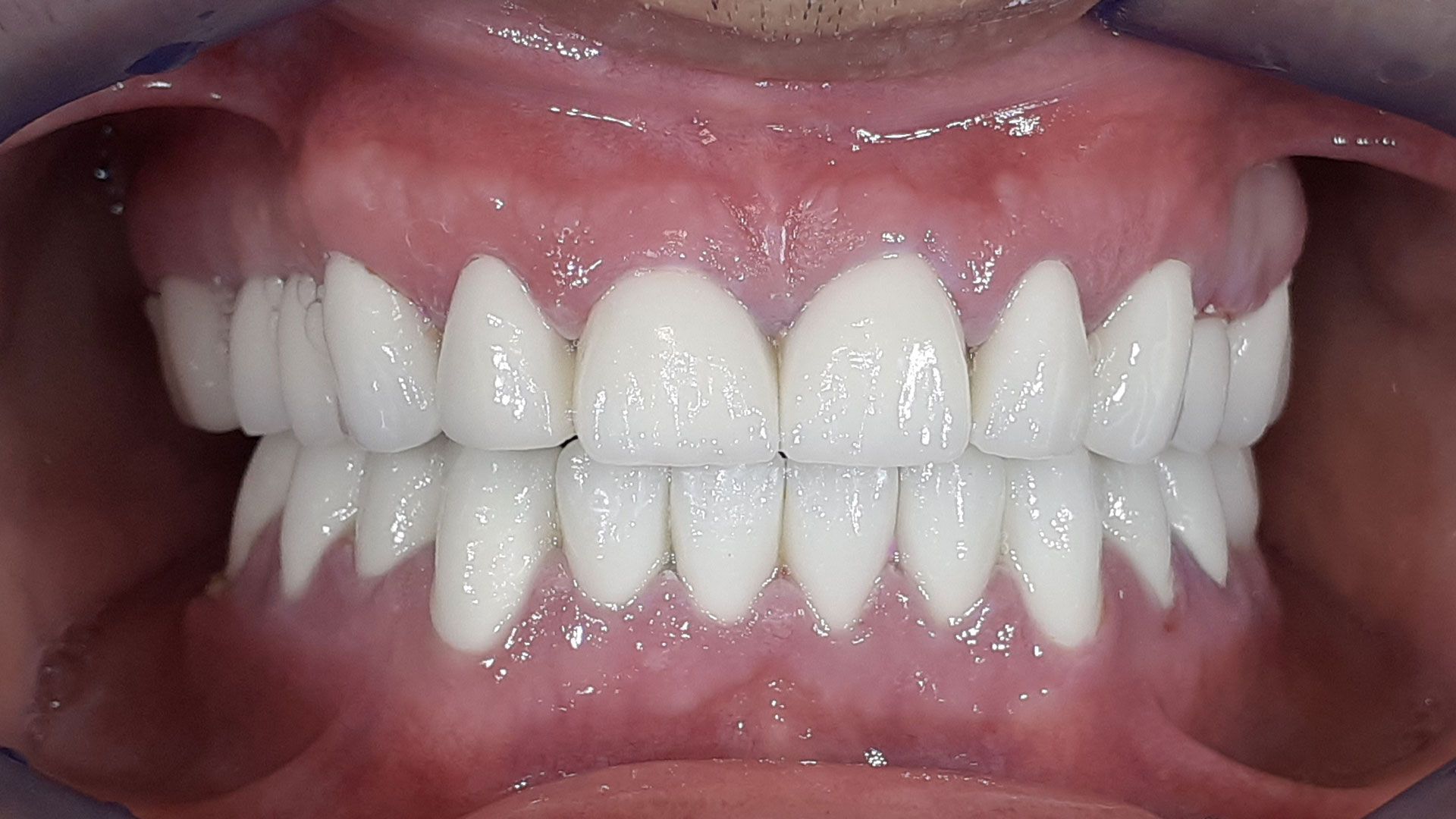 Un primo piano dei denti di una persona con i denti bianchi.